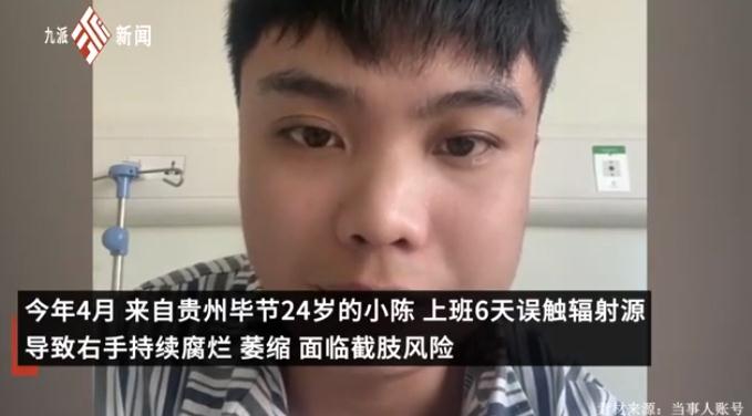 24岁小伙上班6天误触辐射源即将截肢