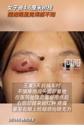 女子眼中插进4.5厘米树枝浑然不知