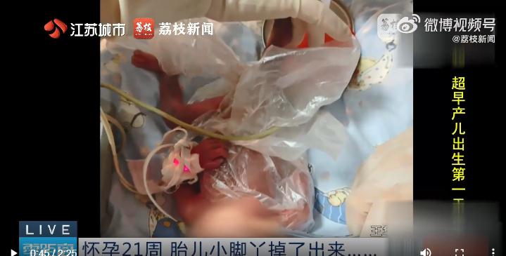 怀孕21周胎儿小脚丫掉了出来