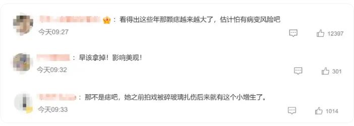 孙俪的唇下痣没了