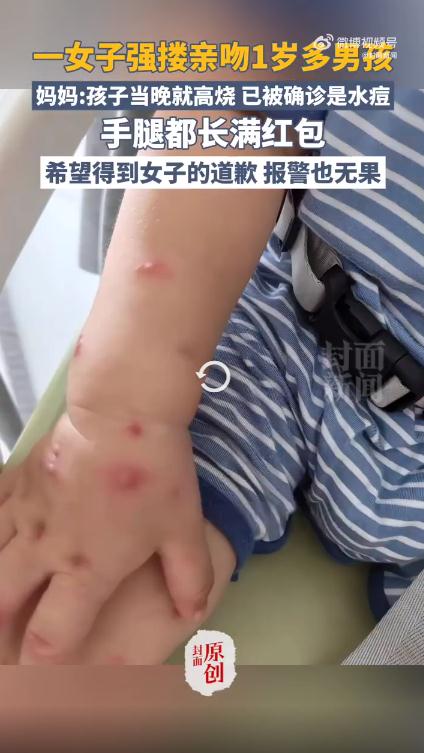 1岁男孩被女子强搂亲吻后发烧得水痘