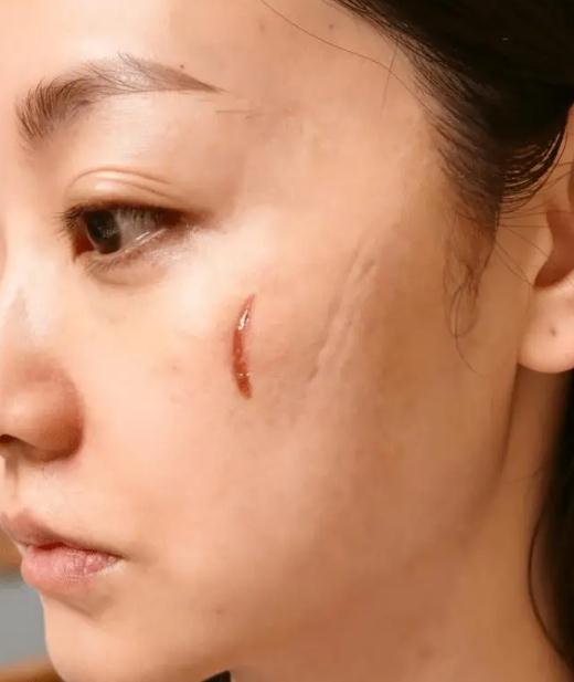 杨蓉晒烫伤后疤痕恢复照