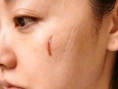 杨蓉晒烫伤后疤痕恢复照 这是什么情况？